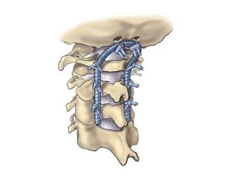 Cranio-vertebral Junction Surgery