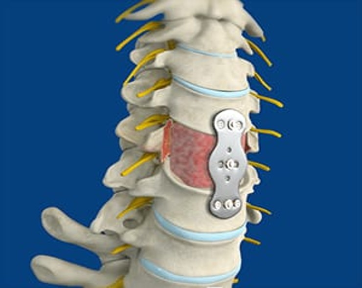 Cervical Spine Surgery