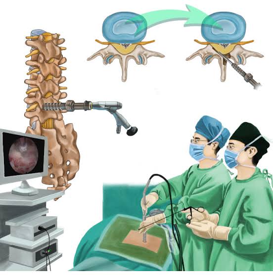 Endoscopic Spine Surgeries